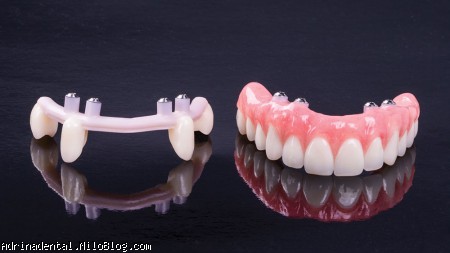 تکنیک جایگزینی ایمپلنت تمام دندان ها