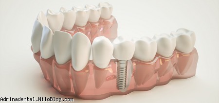 ایمپلنت دندان سه بعدی