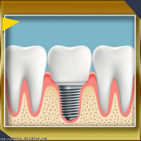 راه حل های کاشت ایمپلنت دندان 