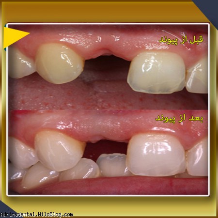 ایمپلنت دندان تقویت استخوان با پیوند استخوان گاو 