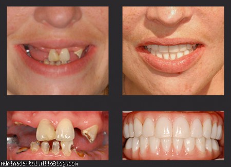 کاشت ایمپلنت خوب با ظاهر طبیعی جایگزین دندانهای متعدد