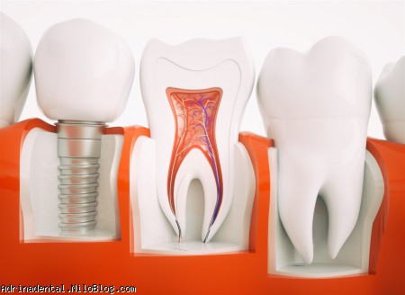 جراحی ایمپلنت دندان ترمیم دندانها