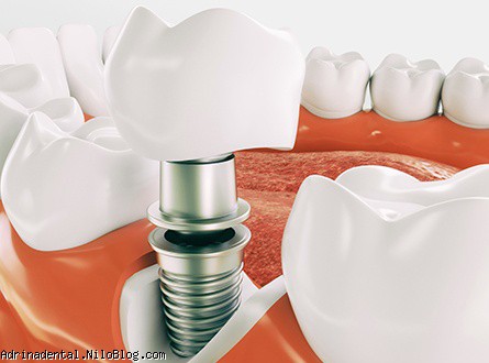 درباره ایمپلنت های دندانی و مراقبت از دنداهای هوشمند 